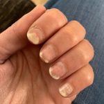 Effective Natural Remedies for Nail Fungus Cure